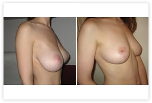 Photo de correction de ptose avec diminution du volume mammaire