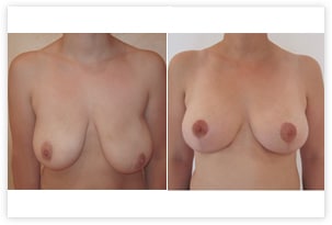 Cure de ptose avec réduction mammaire de 100g à gauche pour correction d'asymétrie