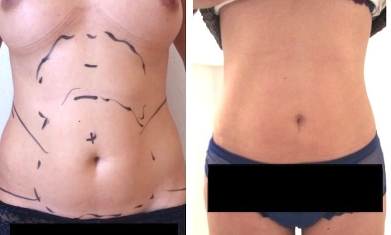 Autre résultat avant après chez une femme