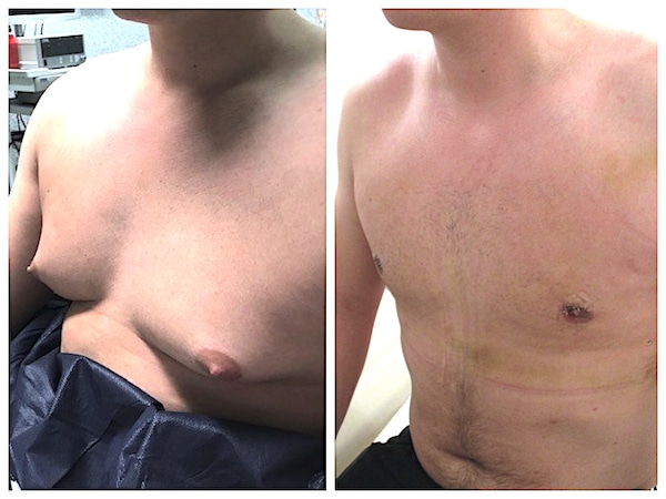 Cicatrice aréolaire après le traitement d'une adipo-gynecomastie