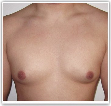 Gynecomastie glandulaire et graisseuse avec excedent cutané modéré