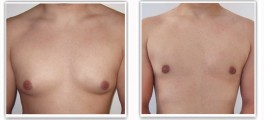 Traitement par cicatrice péri-aréolaire inférieure avec liposuccion (cicatrice axillaire)