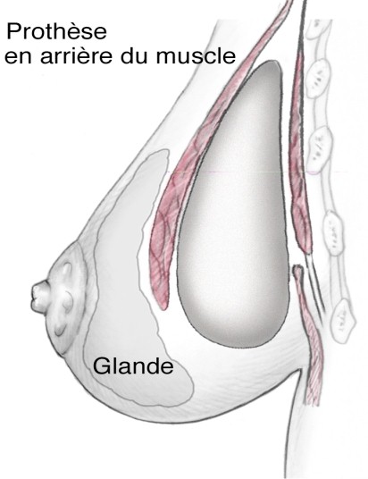 position retromusculaire
