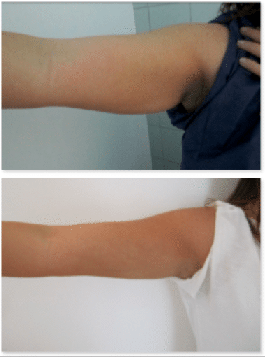 résultat lipoaspiration des bras