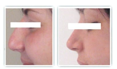 Chirurgie plastique du nez dont la correction a porté sur la bosse et la pointe du nez