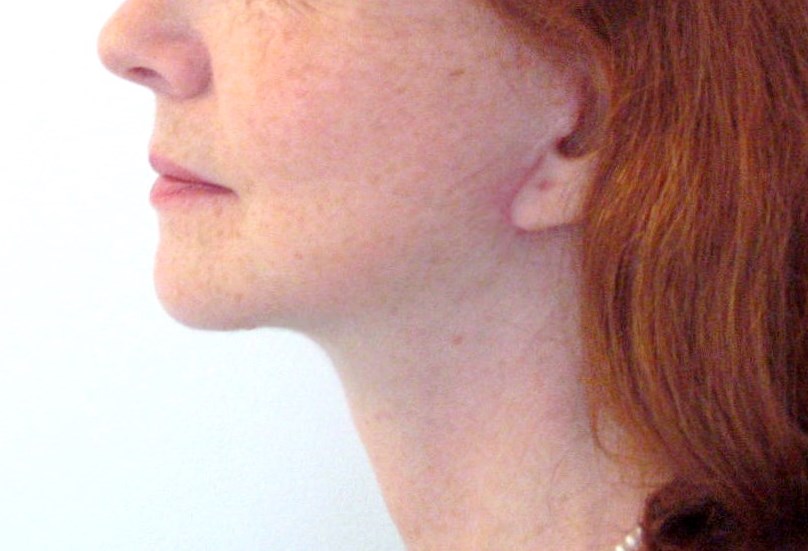 Cicatrice lifting visage cervico facial
