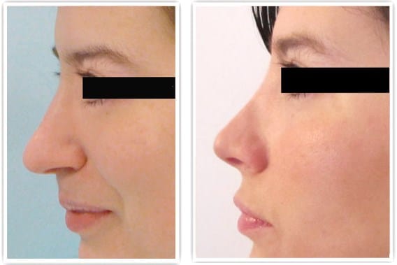 Rhinoplastie de la pointe du nez
