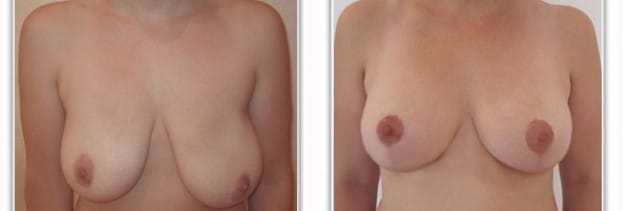 Asymetrie des seins