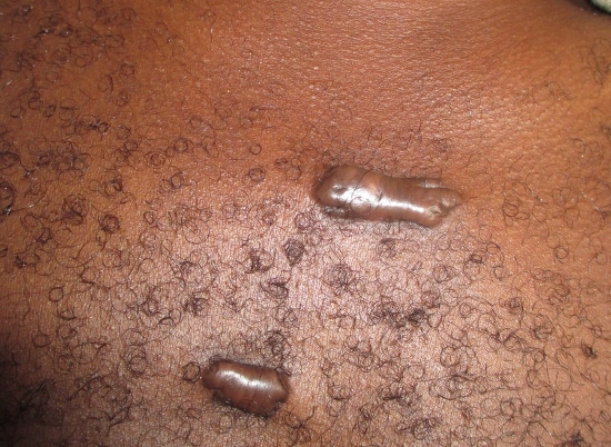 cicatrice cheloide