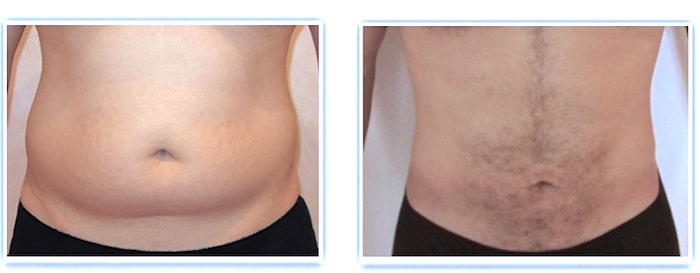 liposuccion-homme