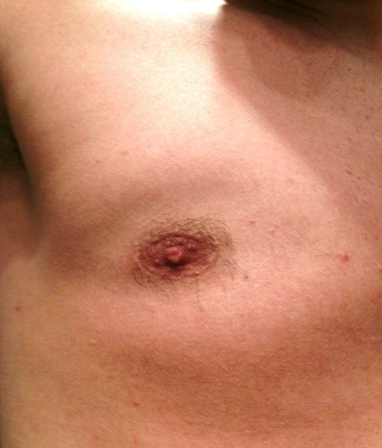 Cause de recidive de gynecomastie