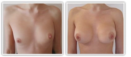 Syndrome de Poland traité par pose d'implants et lipofilling