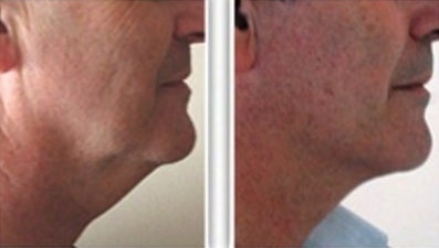 Résultat de lifting du cou chez un homme