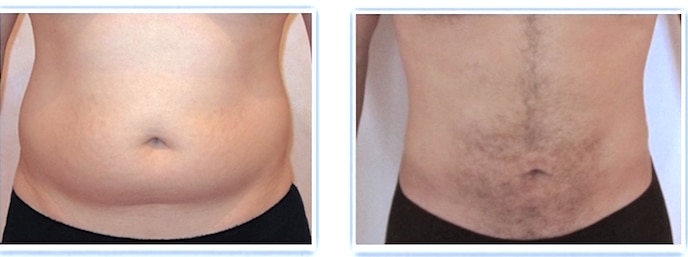 liposuccion-ventre-homme