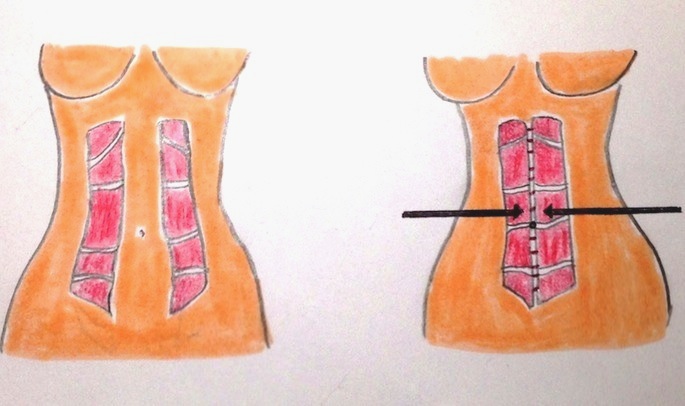 Le diastasis est corrigé par une abdominoplastie