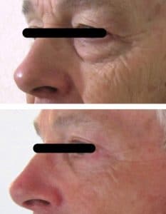 operation-esthetique-paupieres