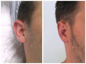 recollement-oreille-homme