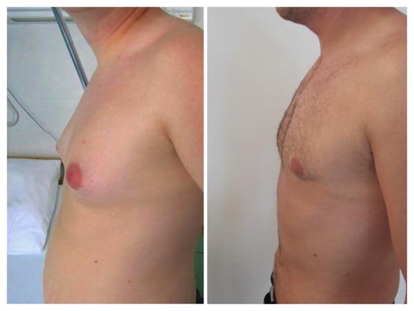 reduction-seins-homme