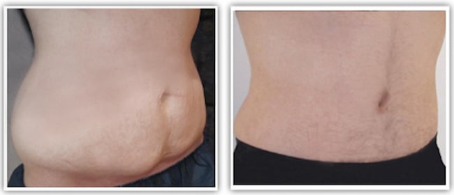 resultat-plastie-abdominale-homme