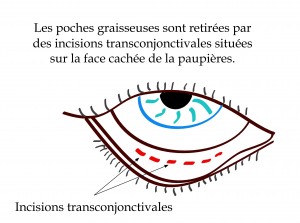 La blépharoplastie inférieure par abord conjonctival permet l'extraction des poches de graisse sans cicatrices visibles.