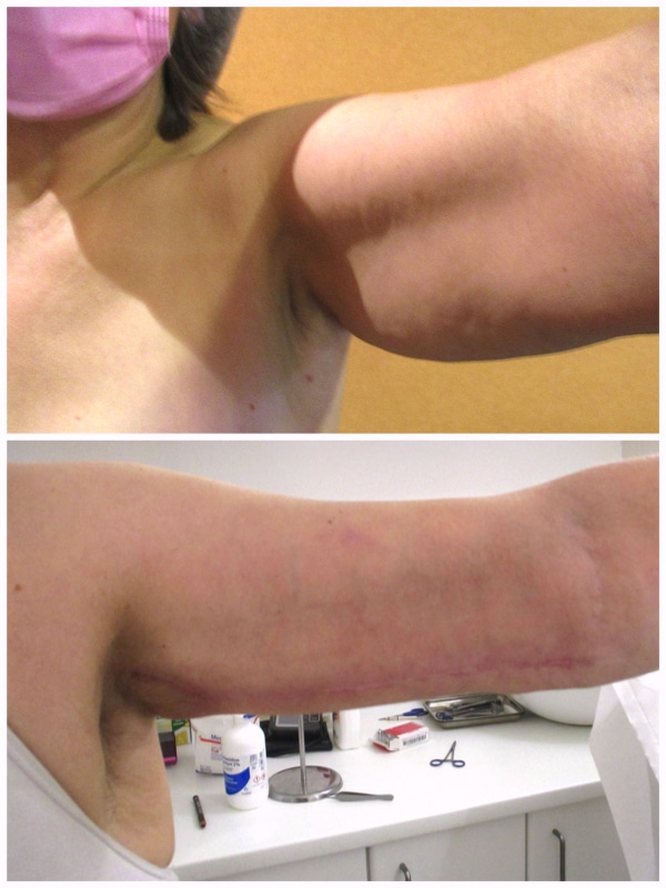 lifting des bras avec cicatrice longitudinale