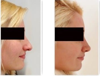 Résultat de rhinoplastie naturelle chez une femme