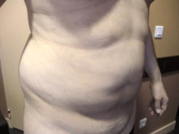 abdominoplastie homme diastasis