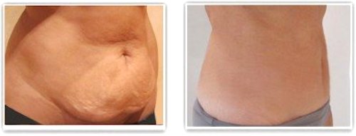 Chirurgie réparatrice abdominale réalisée un an après l'accouchement