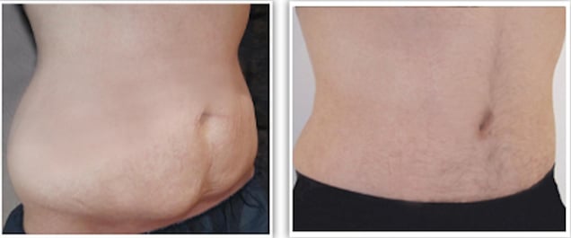 Résultat d'une abdominoplastie après chirurgie bariatrique pour obésité