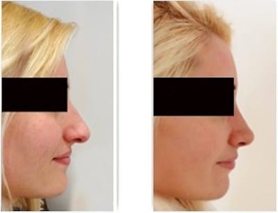 Le morphing et la simulation servent de support pour la consultation pré-opératoire d'une rhinoplastie