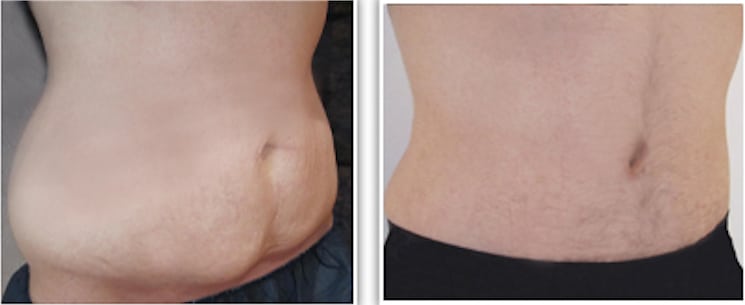resultat-intervention-apres-amaigrissement-chirurgie-obesite