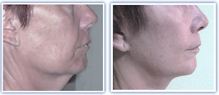 double-menton-exces-cutanee-vieillisement