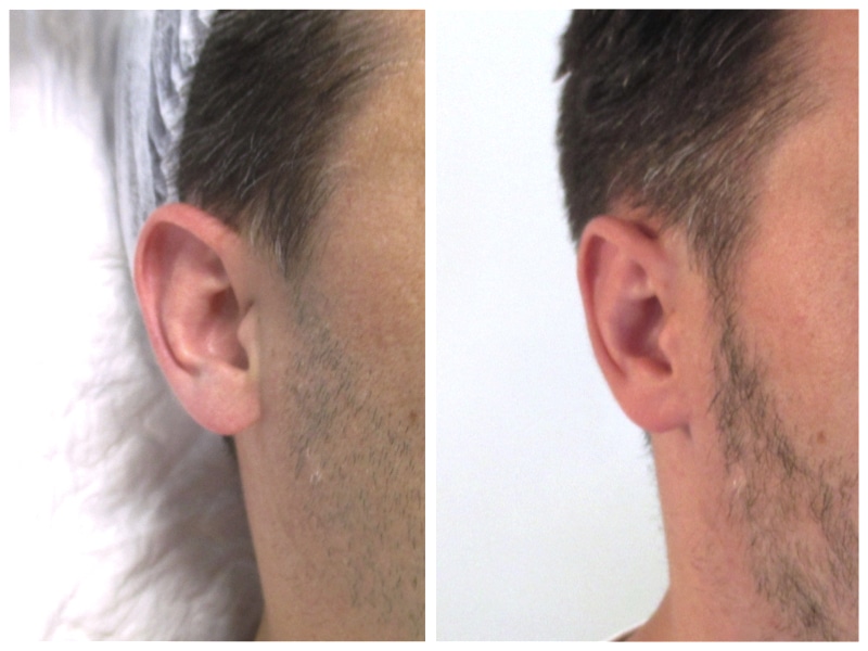 résultat d'un recollement des oreilles 