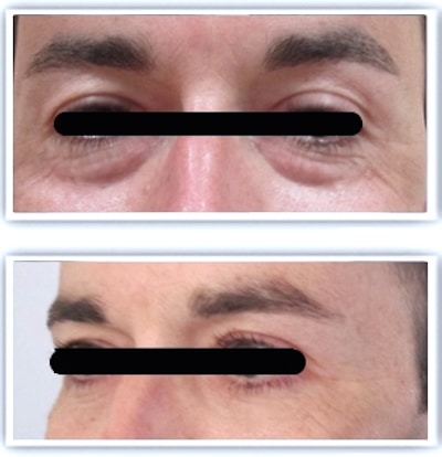 resultat-blepharoplastie-sans-cicatrice