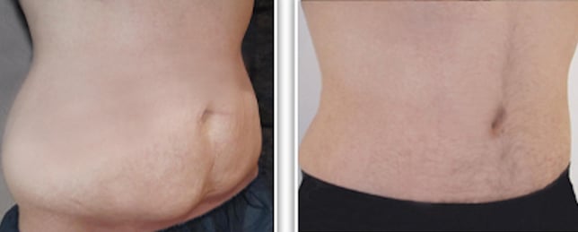 abdominoplastie-homme-age-jeune