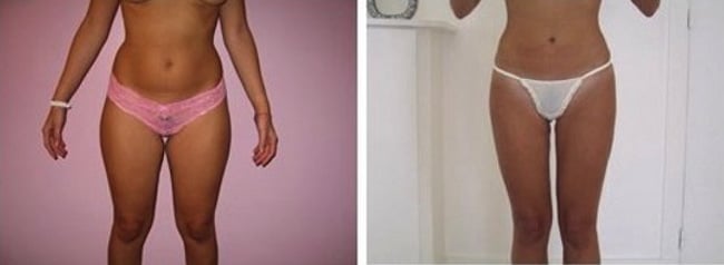 Resultat-lipoaspiration