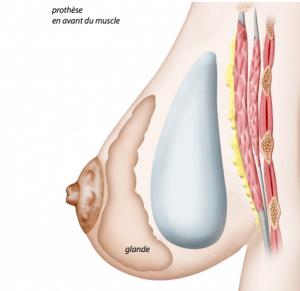 implant-devant-muscle pectoral