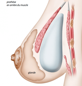 prothese-derriere-muscle-pectoral