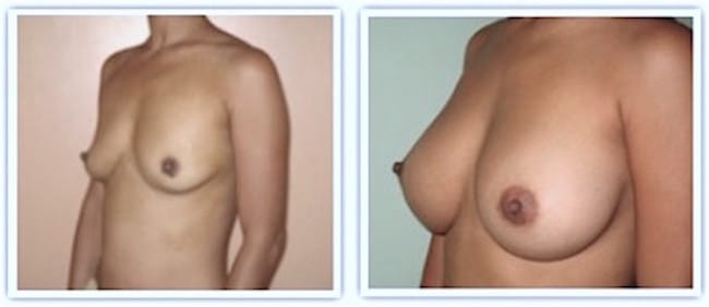 obtention bonnet C apres augmentation
