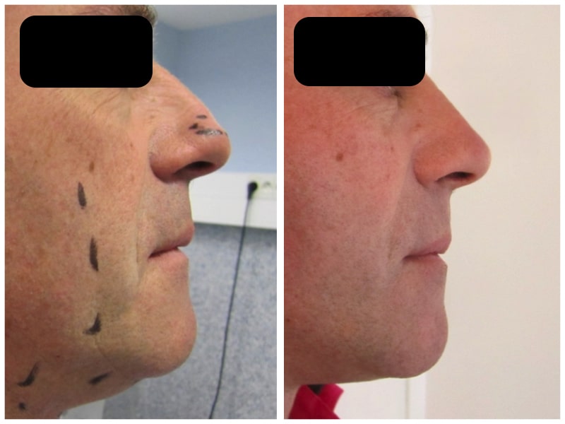 paticularites-rhinoplastie-homme