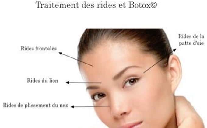 zones-action-indication-botox