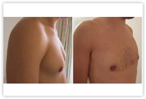 Hypertrophie de la poitrine chez un homme de 28 ans traitée par liposuccion et retrait de la glande