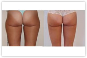 Liposuccion