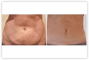 Abdominoplastie localisée (mini-abdominoplastie) avec liposuccion du ventre