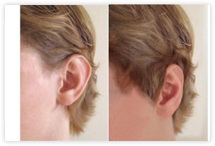 Opération des oreilles décollées