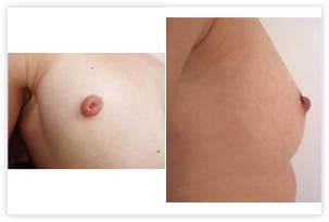 Chirurgie des mamelons invaginés