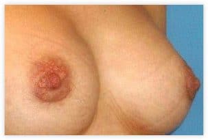 Prothèses mammaires implantées pour augmentation de la poitrine