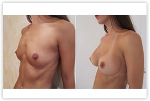 Augmentation mammaire avec implants de 280cc
