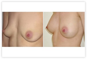 Augmentation mammaire prise en charge par la Sécurité Sociale pour malformation du thorax (en entonnoir)