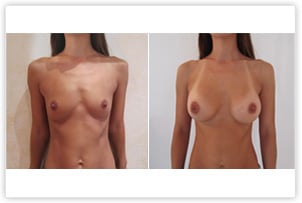 Augmentation mammaire avec prothèses de 280cc